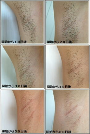 脱毛器ケノン